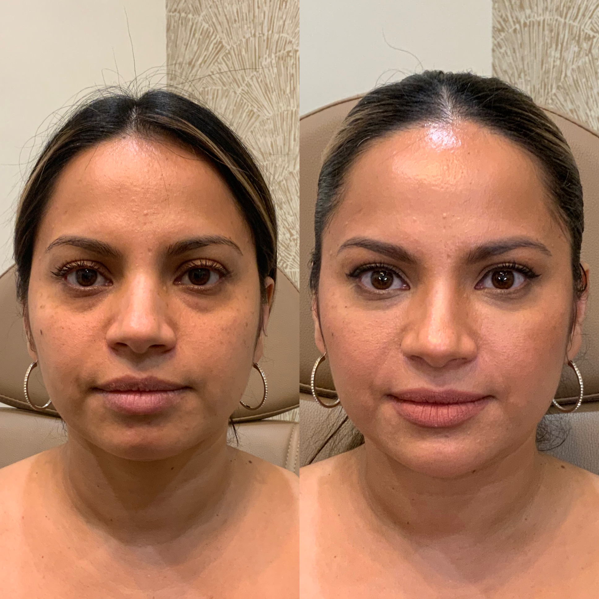 Facial balancing is a personalized treatment that enhances features to create a harmonious look.