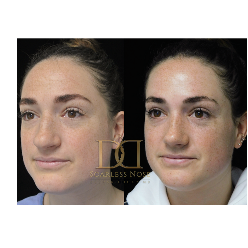 Individuals considering closed scarless rhinoplasty are often seeking a procedure that enhances their nose's appearance while ensuring minimal visible scarring.