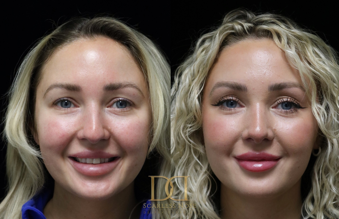 Many patients visit Beverly Hills Rhinoplasty Center for closed scarless rhinoplasty, a procedure that reshapes the nose without visible scars.