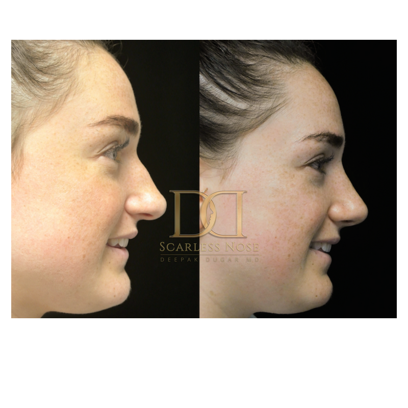 Your appointment for nose surgery begins with a detailed consultation with Dr. Deepak Dugar, a Double Board-Certified Rhinoplasty Surgeon.