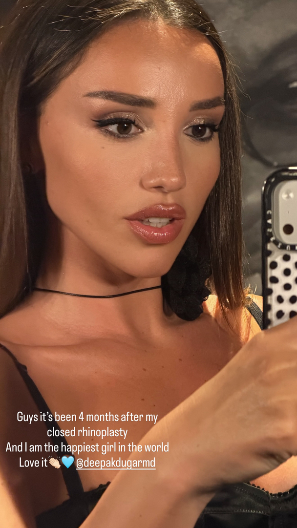 Closed rhinoplasty is a surgical procedure that reshapes the nose through incisions made inside the nostrils, resulting in minimal visible scarring.