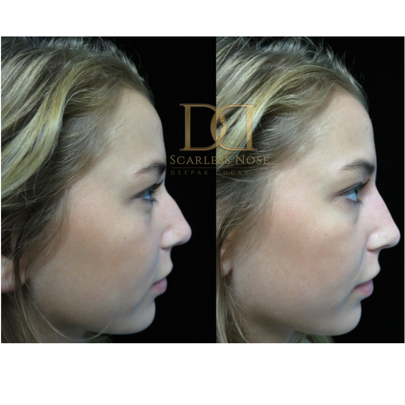 As the summer heat peaks, many are considering closed scarless rhinoplasty, a procedure renowned for its natural-looking results tailored to each patient.