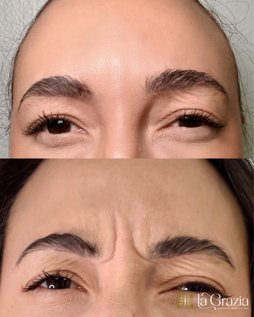 People who want to reduce the appearance of fine lines and wrinkles may find injection Botox to be a suitable option.